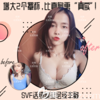 北京京韓王沛森自體脂肪隆胸案例 北京京韓王沛森自體脂肪隆胸案例