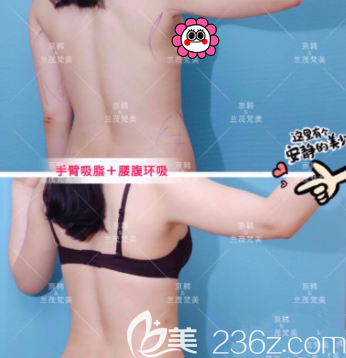 北京京韓王沛森手臂腰腹吸脂案例 北京京韓王沛森手臂腰腹吸脂案例