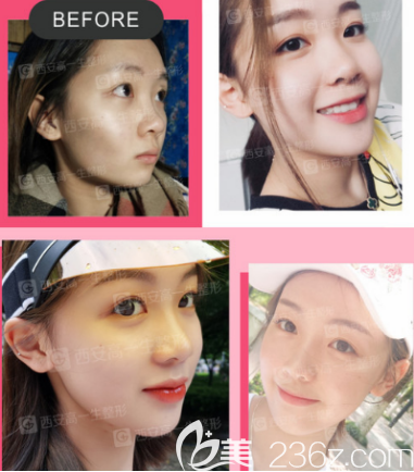 西安高一生自體脂肪填充面部案例2