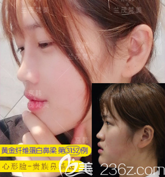 北京京韓張振醫(yī)生心形臉+鼻基底填充案例 北京京韓張振醫(yī)生心形臉+鼻基底填充案例