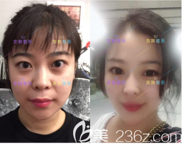 北京京韓張振醫(yī)生埋線(xiàn)提升案例 北京京韓張振醫(yī)生埋線(xiàn)提升案例