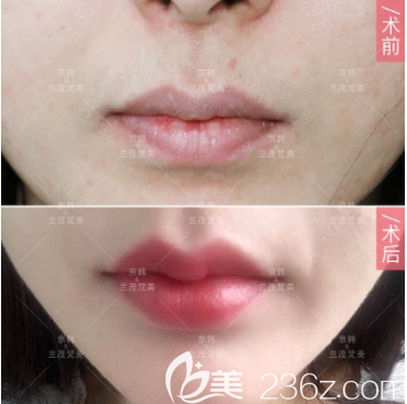 北京京韓張振醫(yī)生玻尿酸豐唇案例 北京京韓張振醫(yī)生玻尿酸豐唇案例