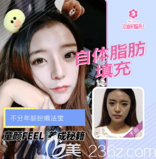 濟(jì)南海峽自體脂肪填充面部案例