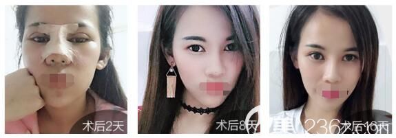 曾高醫(yī)生隆鼻案例