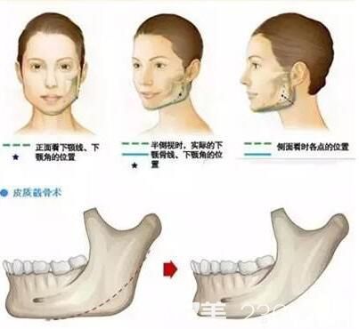 下頜角整形的手術(shù)方式