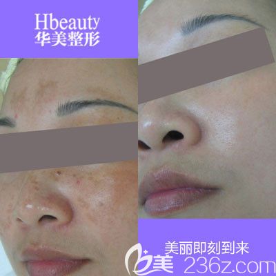 畢小利醫(yī)生祛斑案例對(duì)比