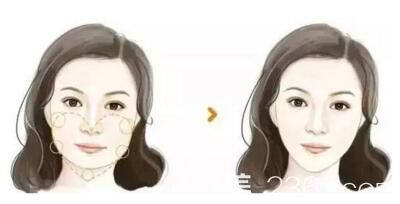 下頜角整形術(shù)前術(shù)后對(duì)比效果