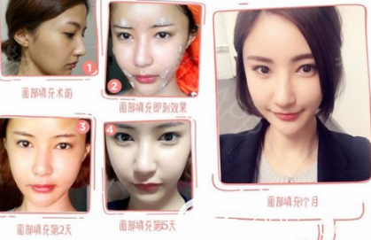 京韓自體脂肪填充面部案例