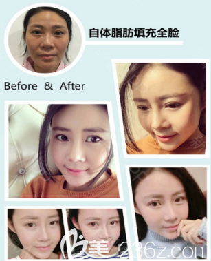 煙臺(tái)洛神自體脂肪填充面部案例