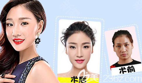 煙臺(tái)鵬愛(ài)醫(yī)院自體脂肪填充案例