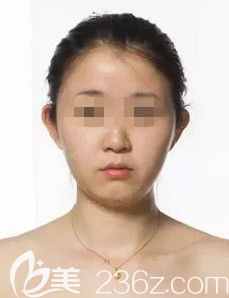 在石家莊雅芳亞做假體隆下巴前是短下巴 在石家莊雅芳亞做假體隆下巴前是短下巴