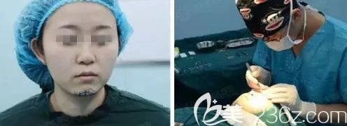 丁慶豐院長為我做假體豐下巴術前設計 丁慶豐院長為我做假體豐下巴術前設計