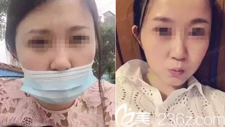 在石家莊雅芳亞做假體隆下巴術后7天微腫 在石家莊雅芳亞做假體隆下巴術后7天微腫