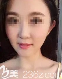 天生下巴短在石家莊雅芳亞做膨體隆下巴1個(gè)月后我的大餅?zāi)樉挂材芡懽冃臉