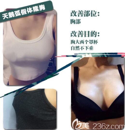 哈爾濱臻美天鵝弧假體隆胸效果