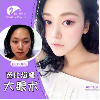 佛山醫(yī)博士劉哲醫(yī)生雙眼皮案例 佛山醫(yī)博士劉哲醫(yī)生雙眼皮案例