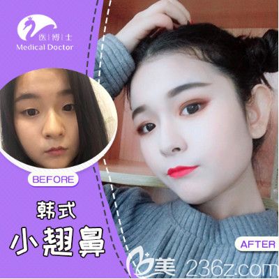 佛山醫(yī)博士門診劉哲隆鼻案例 佛山醫(yī)博士門診劉哲隆鼻案例