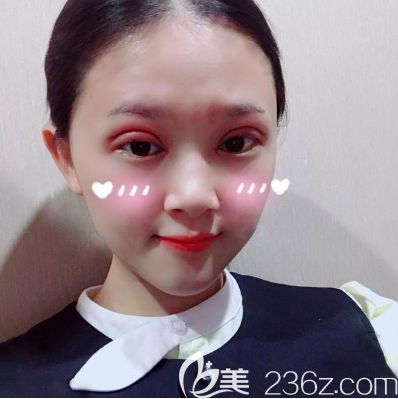 在佛山醫(yī)博士做完全切雙眼皮兩天了