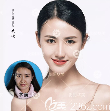 貴陽(yáng)華美鼻綜合案例