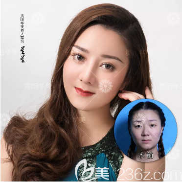 貴陽(yáng)華美玻尿酸填充案例