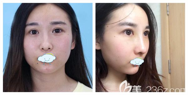 孝感天妃整形柳肖主任硅膠隆鼻綜合術(shù)后5天前后對(duì)比圖展示