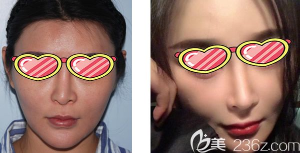 呼和浩特大韓整形白惠援醫(yī)生歪鼻矯正效果好不好