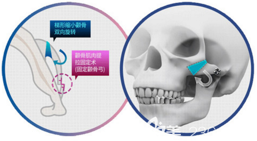 顴骨內(nèi)推案例
