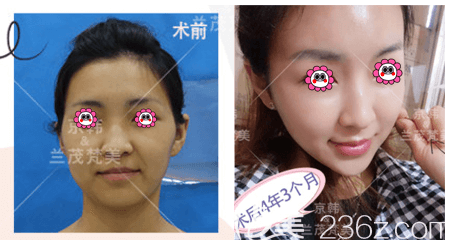 北京京韓喬愛軍面部脂肪填充 北京京韓喬愛軍面部脂肪填充