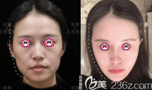 北京京韓喬愛軍面部吸脂 北京京韓喬愛軍面部吸脂