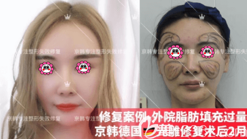 北京京韓喬愛軍面部脂肪修復(fù) 北京京韓喬愛軍面部脂肪修復(fù)