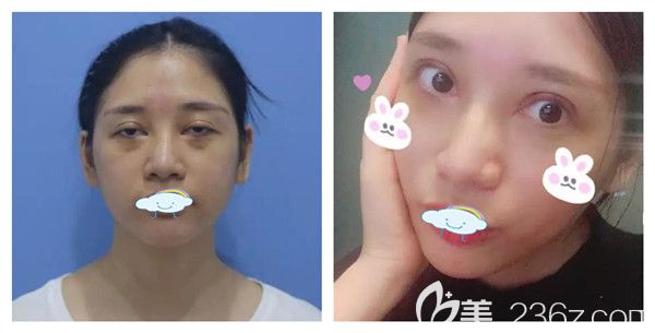 孝感天妃醫(yī)美整形柳肖主任雙眼皮修復(fù)術(shù)后7天案例