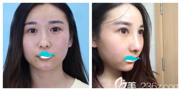 孝感天妃硅膠隆鼻綜合術(shù)后5天對(duì)比照