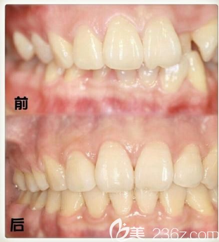 種植二期美學(xué)修復(fù)