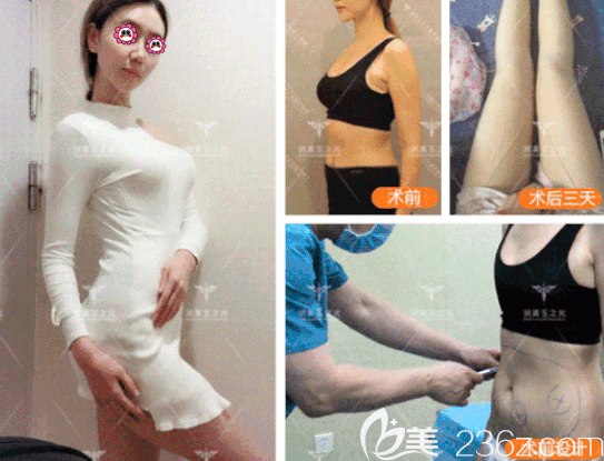 北京潤(rùn)美玉之光谷利衛(wèi)醫(yī)生腿部+腰腹部吸脂案例 北京潤(rùn)美玉之光谷利衛(wèi)醫(yī)生腿部+腰腹部吸脂案例