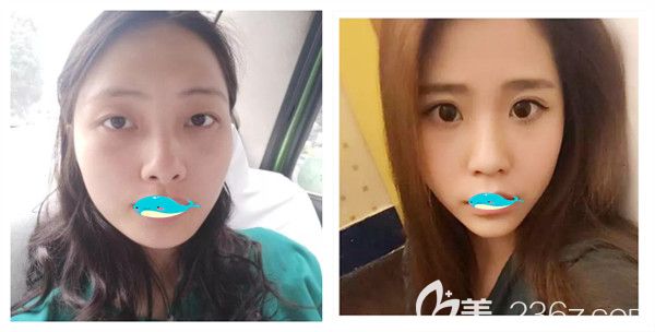 孝感天妃整形醫(yī)院假體隆鼻+瘦臉真實術后案例