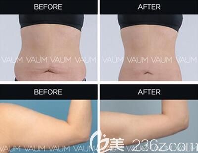 20190411_1554963792481743.jpg 吸脂手術(shù).jpg