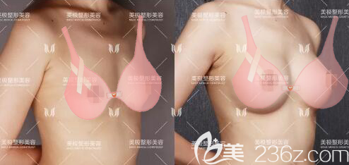 成都美極整形醫(yī)院達(dá)文隆胸術(shù)后對比圖 成都美極整形醫(yī)院達(dá)文隆胸術(shù)后對比圖