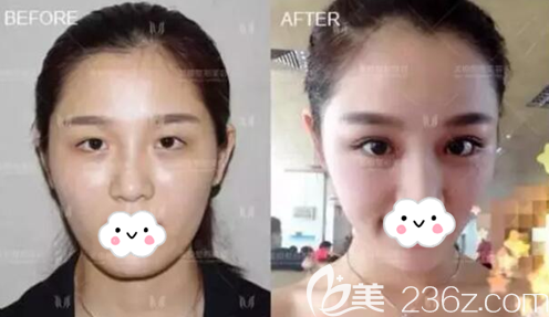 成都美極達(dá)文雙眼皮術(shù)后效果 成都美極達(dá)文雙眼皮術(shù)后效果