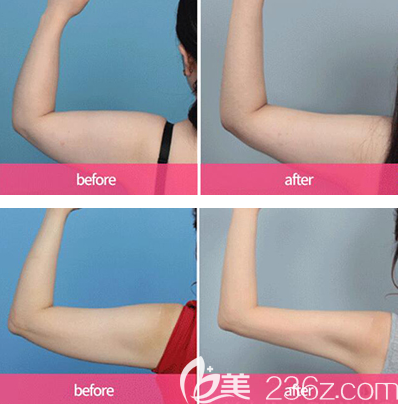 韓國VAUM整形外科胳膊吸脂效果圖 韓國VAUM整形外科胳膊吸脂效果圖