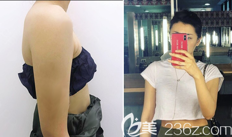 成都美極王偉手臂吸脂術(shù)后效果圖
