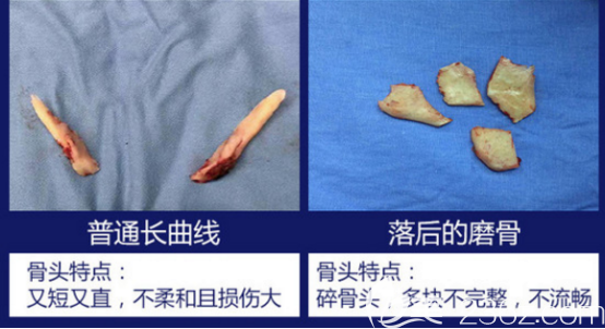 切除的下頜角樣子