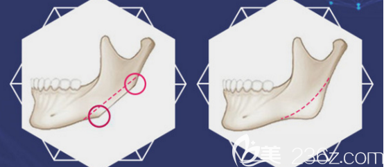 切除下頜角的手術(shù)示意圖