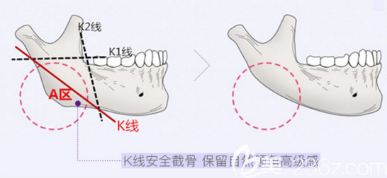下頜角切除示意圖