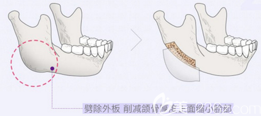 下頜角切除示意圖2