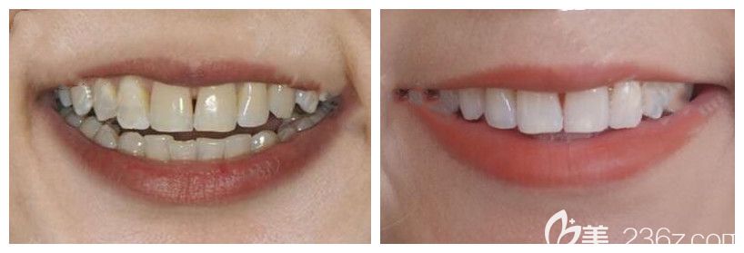 青島維樂口腔董旭濤醫(yī)生牙齒冷光美白案例 青島維樂口腔董旭濤醫(yī)生牙齒冷光美白案例
