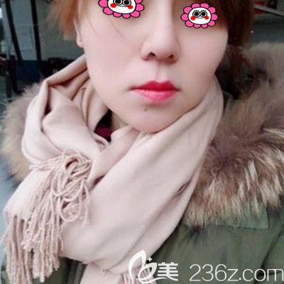 湘潭雅美做膨體隆鼻兩年了，較近打算再去做個鼻翼縮小術
