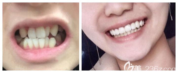 青島維樂口腔孫雪醫(yī)生隱形牙齒矯正案例 青島維樂口腔孫雪醫(yī)生隱形牙齒矯正案例