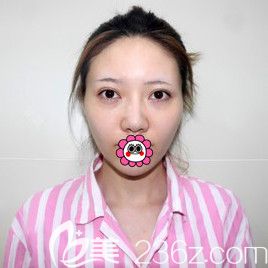 沒做鼻子之前鼻梁比較低 沒做鼻子之前鼻梁比較低