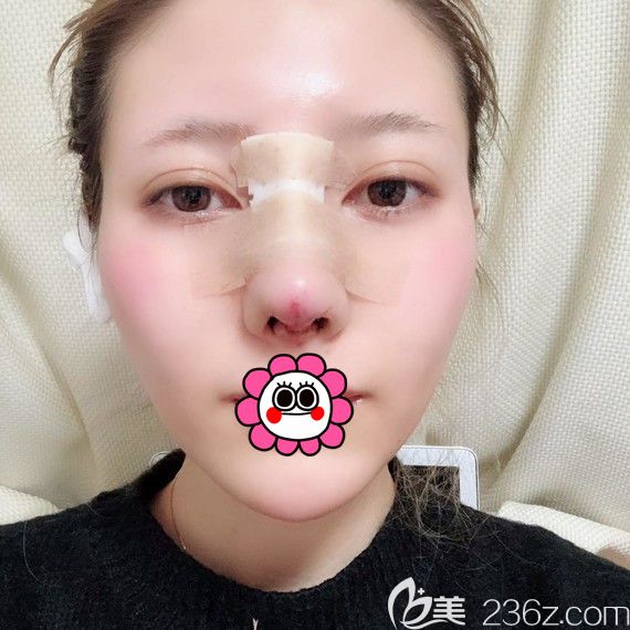 哈爾濱臻美鼻綜合術(shù)后即刻 哈爾濱臻美鼻綜合術(shù)后即刻