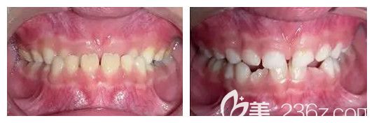 青島維樂口腔楊春犁醫(yī)生兒童反頜矯正效果圖 青島維樂口腔楊春犁醫(yī)生兒童反頜矯正效果圖